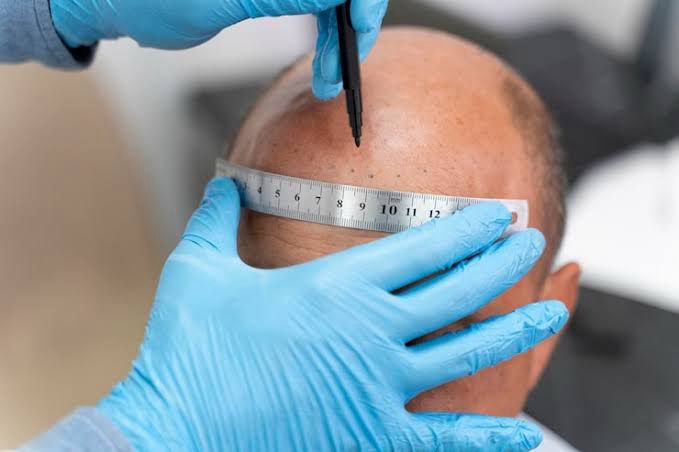 Hair Transplant in Bhilai-Durg