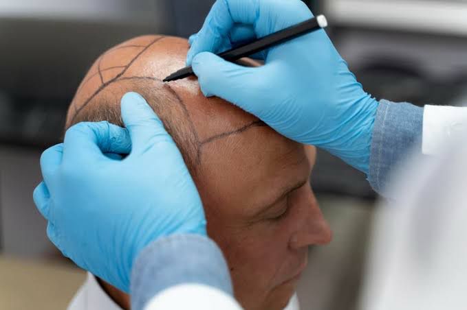 hair restoration expert in-bhilai
